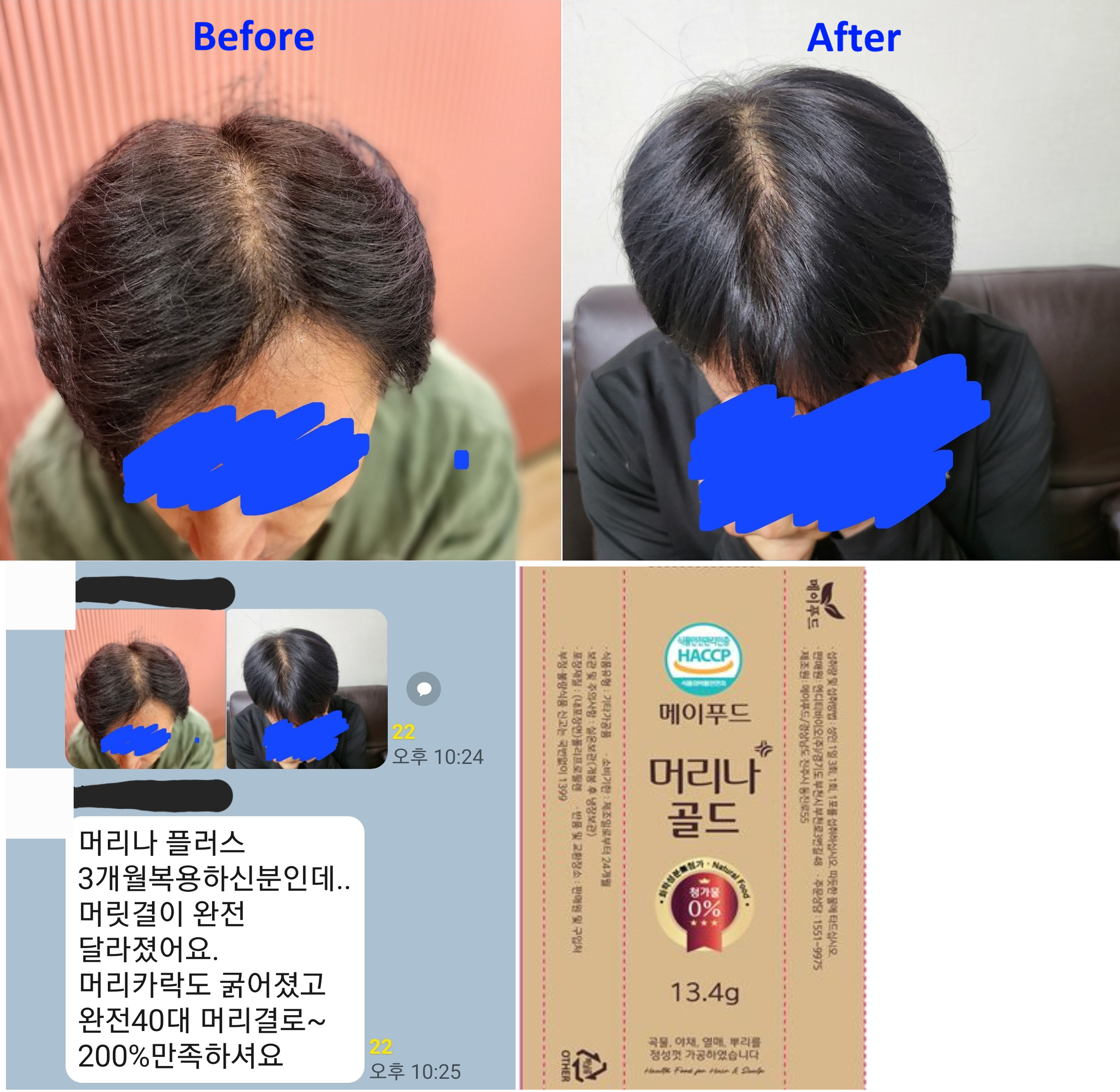 머리나골드 복용후 Befor & After