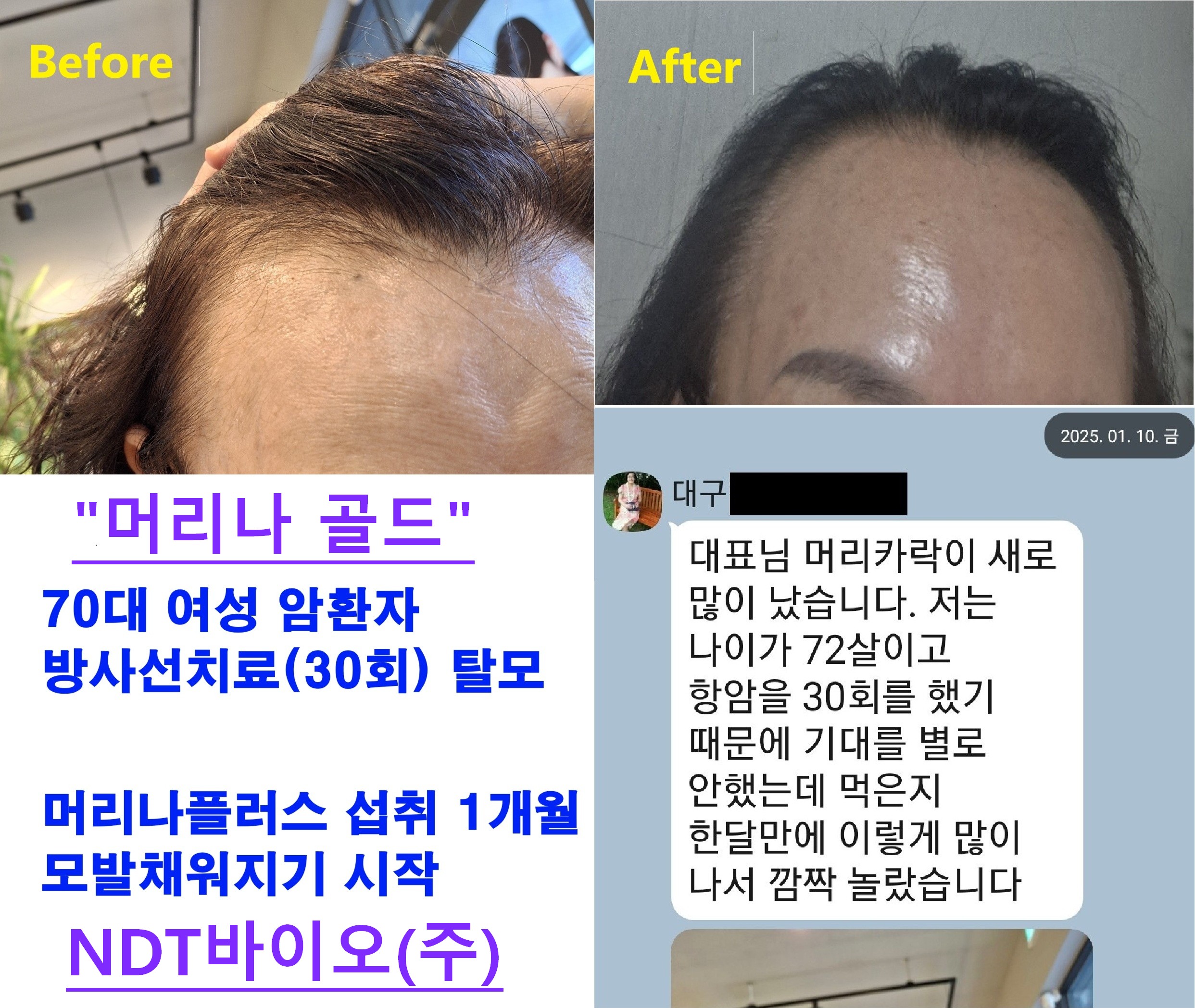 머리나골드 복용후 Befor & After